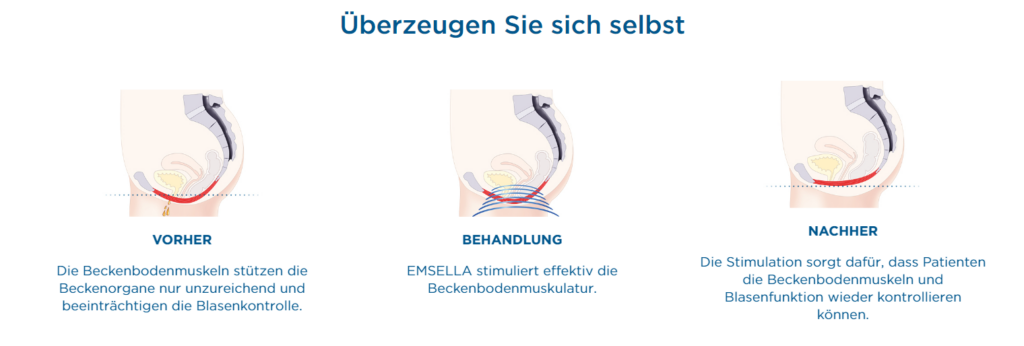 Schema der Behandlung mit EMSELLA®